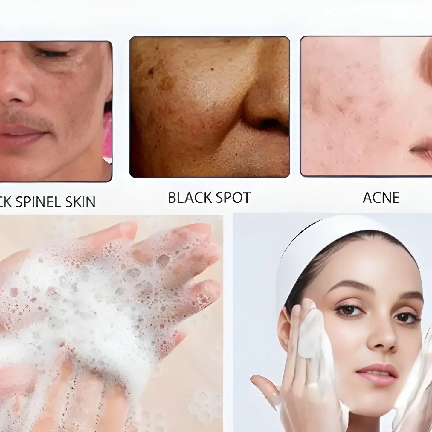 Acne Spot Treatment Lotion