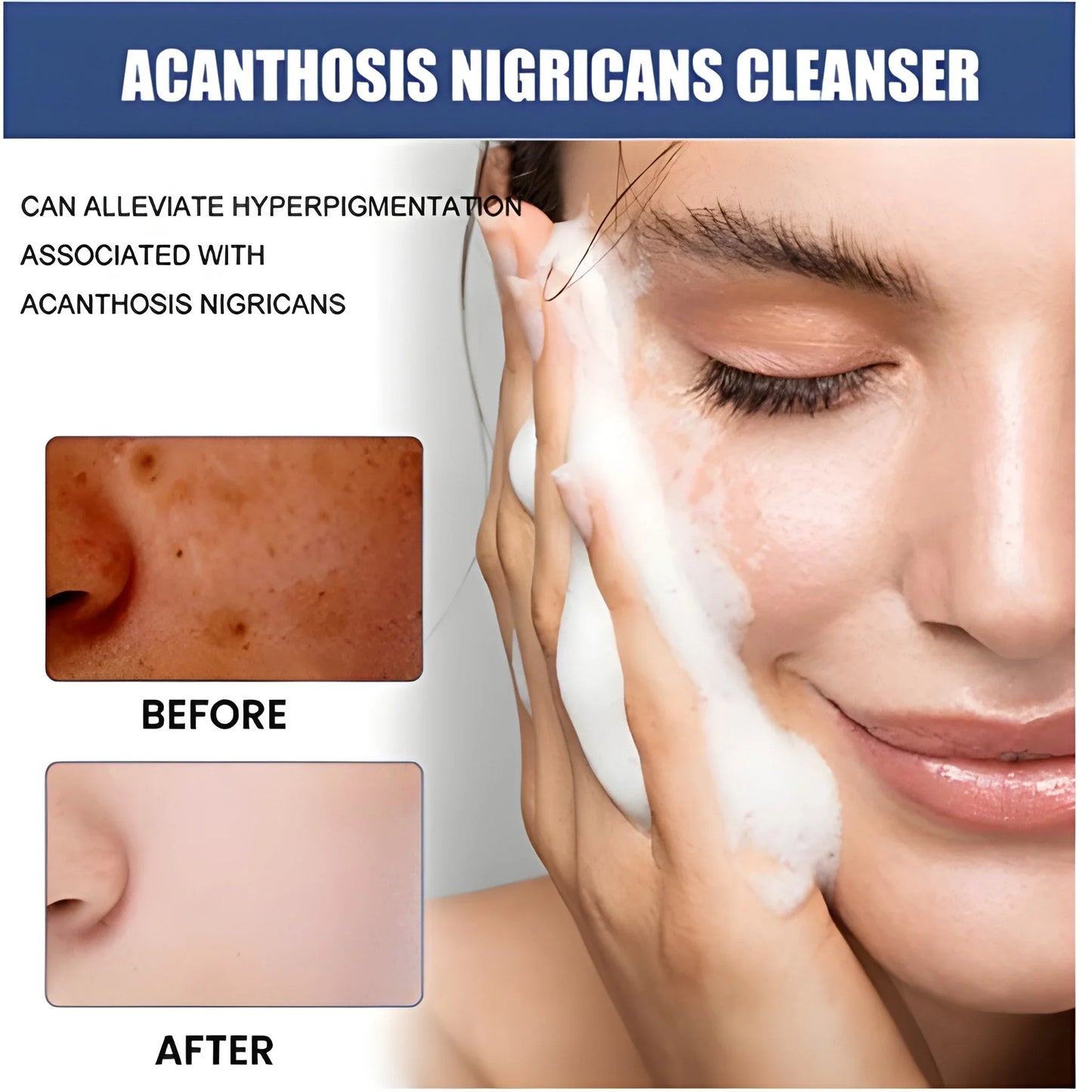 Acne Spot Treatment Lotion