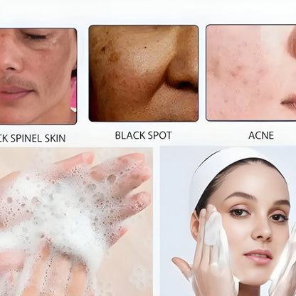 Acne Spot Treatment Lotion