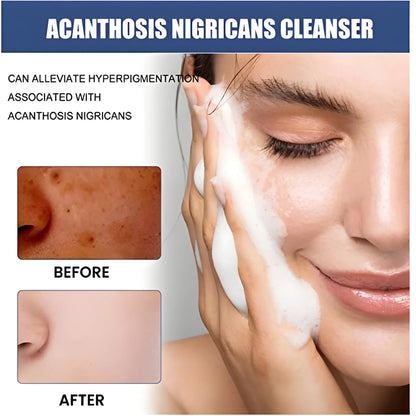 Acne Spot Treatment Lotion